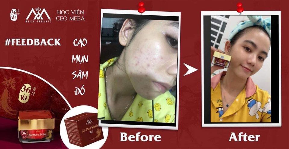 14330-csf210-3-9.jpg Cao Mụn Sâm Đỏ 36 Vị MeeA Organic Loại Lớn 15g - 8938534672009