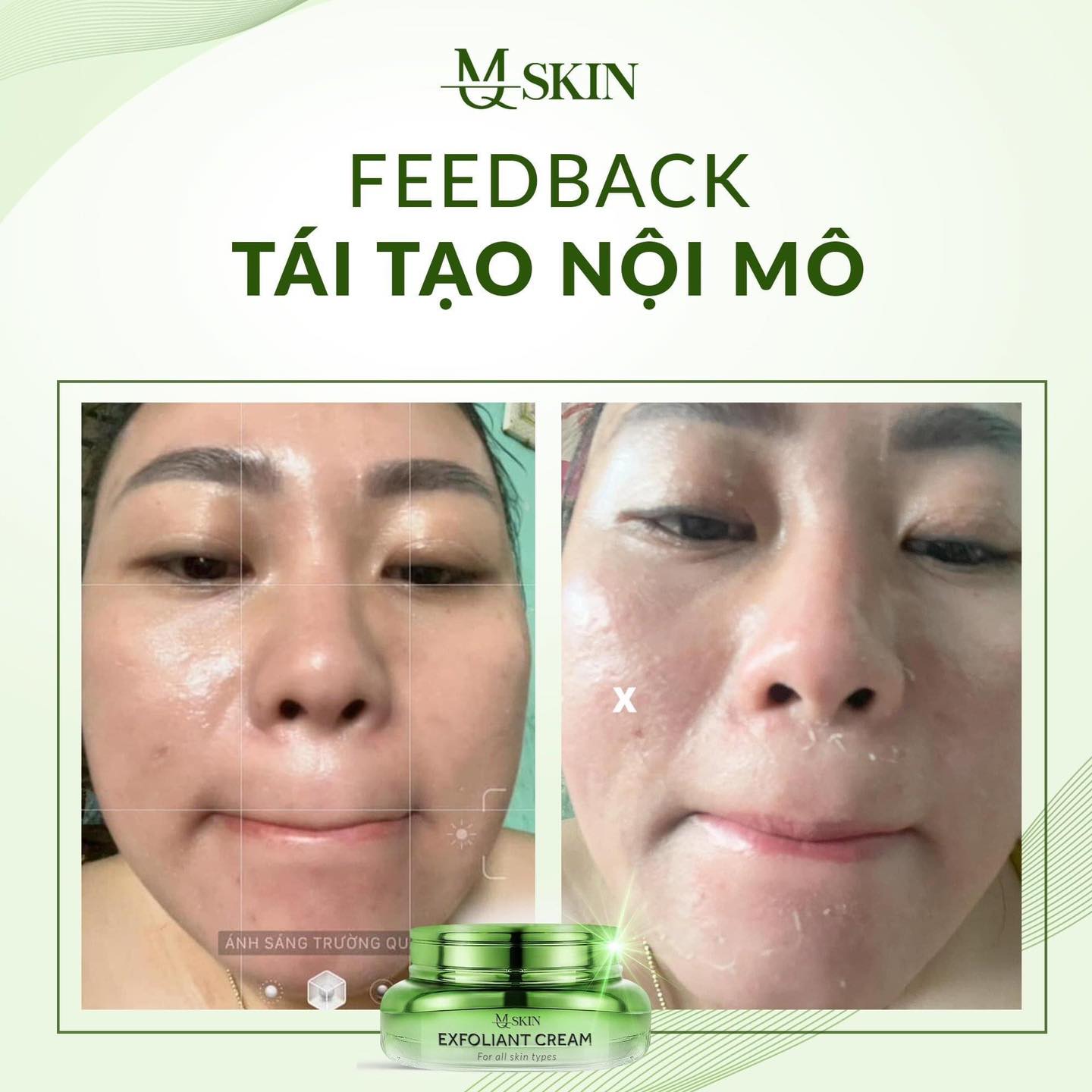 Kem Face Tái Tạo Nội Sinh Exfoliant Cream MQ Skin Tặng Kem Dưỡng HA - 8936117150913