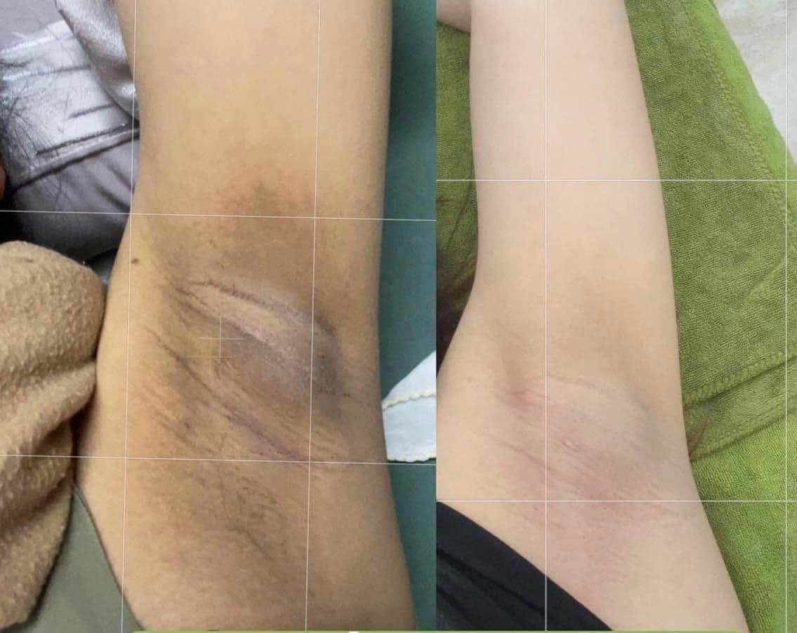 20656-17777-z3774624583299-754f4555320494fbb38884f2bb4d8b91-6.jpg Kem Giảm Thâm Nách Q Nic Care Thái Lan Phiên Bản Mới - QNIC01