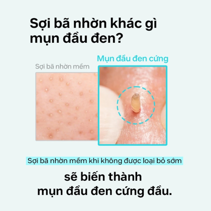 Ủ Mụn ilso Super Melting Sebum Softener 150g  giúp loại bỏ mụn đầu đen mụn cám hiệu quả